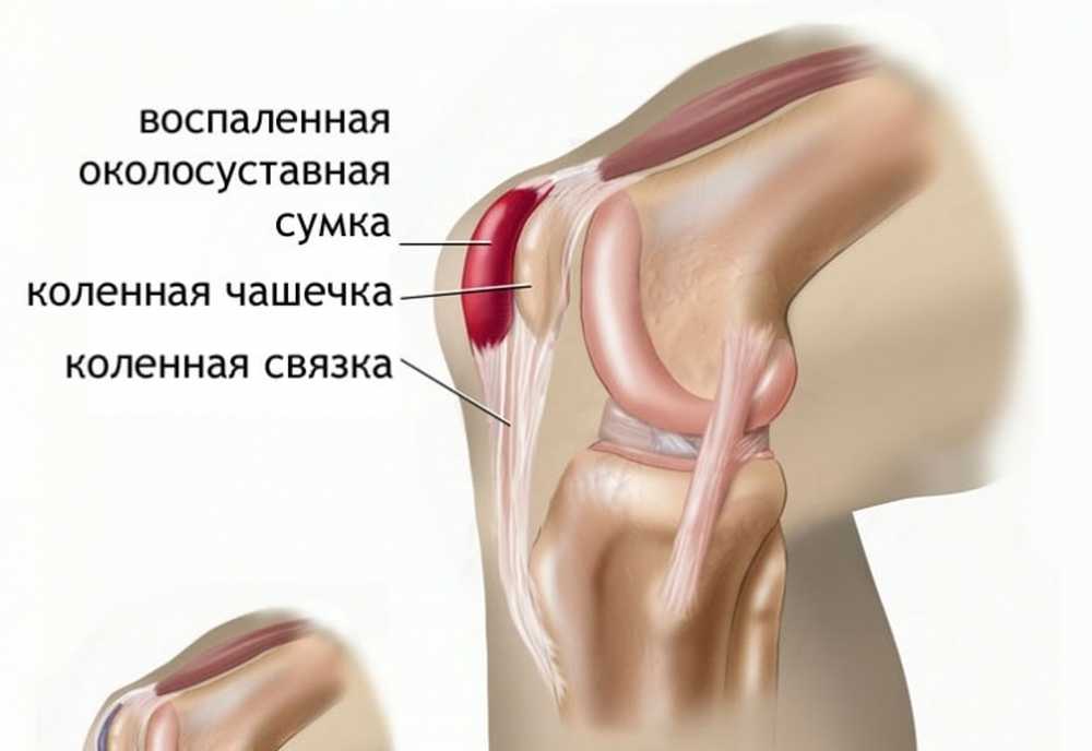 Болит при сгибании и разгибании ноги. Препателлярный бурсит. Анзериновый бурсит коленного сустава. Инфрапателлярный бурсит коленного.