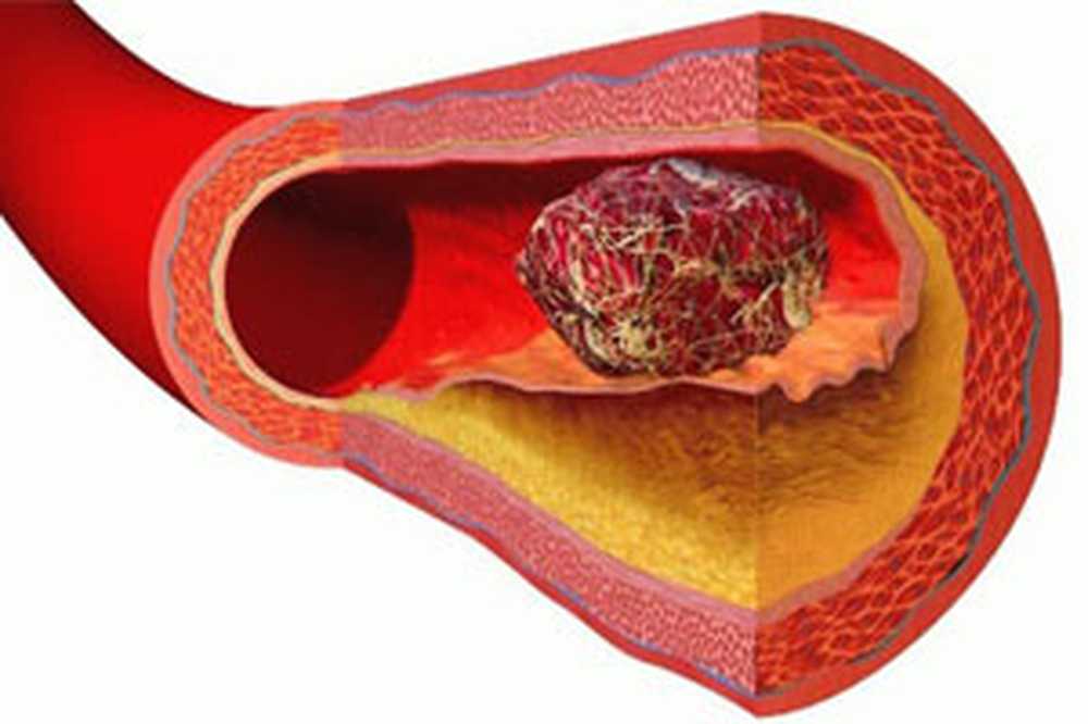 Тромбоз артерия и вена. Атеросклеротическая бляшка.