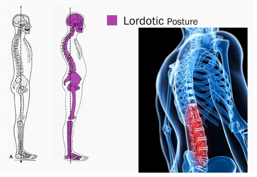 Прямой позвоночник без изгибов. Лордоз поясничного отдела позвоночника. Лордоз грудного отдела позвоночника. Сглажен лордоз в поясничном отделе позвоночника. Лордоз и кифоз позвоночника.