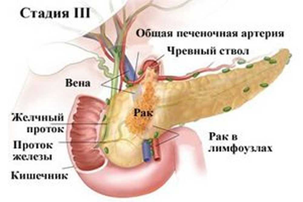 Удаляют ли поджелудочную железу полностью. 3 Стадия поджелудочной железы. Стадии онкологии поджелудочной железы. Онкология поджелудочной железы симптомы. Опухоль поджелудочной железы 3 стадия.