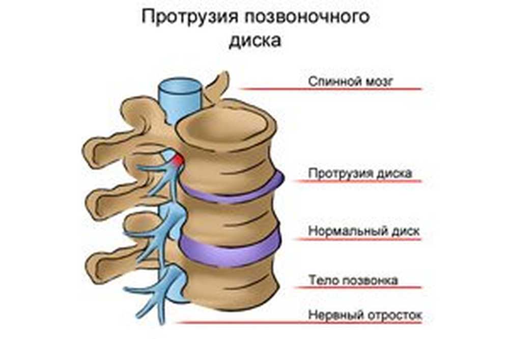 Грыжа позвоночника что это такое