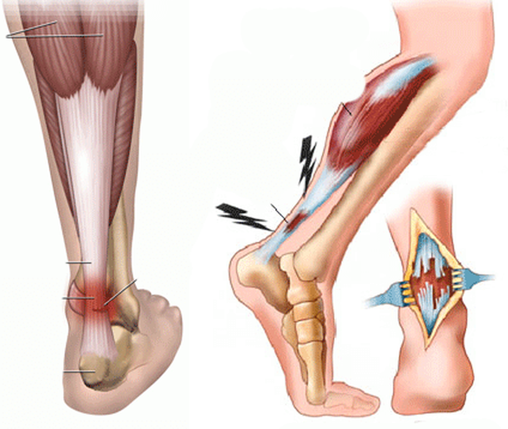 Операция на мышцах ног. Тендинит ахиллова сухожилия. Тендинопатия ахиллова сухожилия. Растяжение ахиллова сухожилия. Тендинит ахиллова сухожилия рентген.