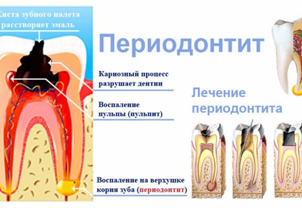 Пульпит Зуба Лечение Цена