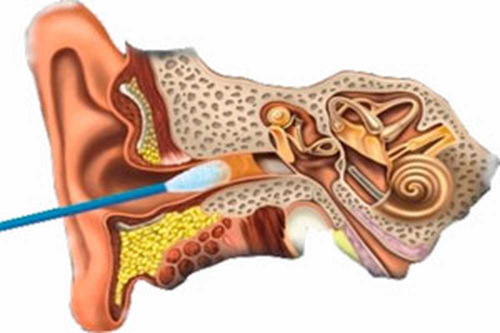 Заложило ухо ватной палочкой что делать. Серная пробка на барабанной перепонке.
