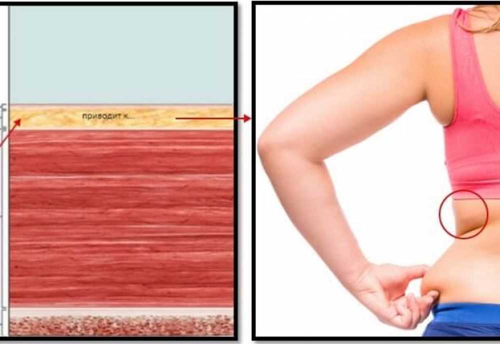 Причина толстых рук. Жир скапливается на спине. Жир в нижней части спины. Жировые отложения на мышцах.