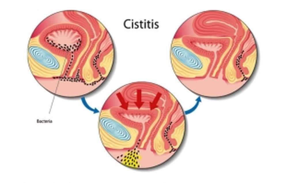 Причины появления цистита. Женский цистит.