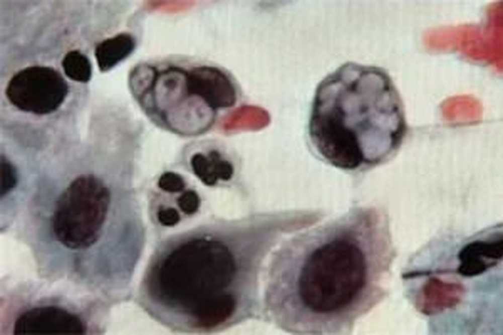 Хламидиоз клинические проявления. Хламидиоз может пройти сам. Хламидиоз методы диагностики. Хламидиоз может пройти сам. Пути заражения хламидиозом.