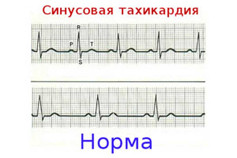 Желудочковый ритм. Экг синусовая тахикардия пленка. Синусовая тахикардия этиология. Что значит умеренная тахикардия. Что значит умеренная тахикардия.
