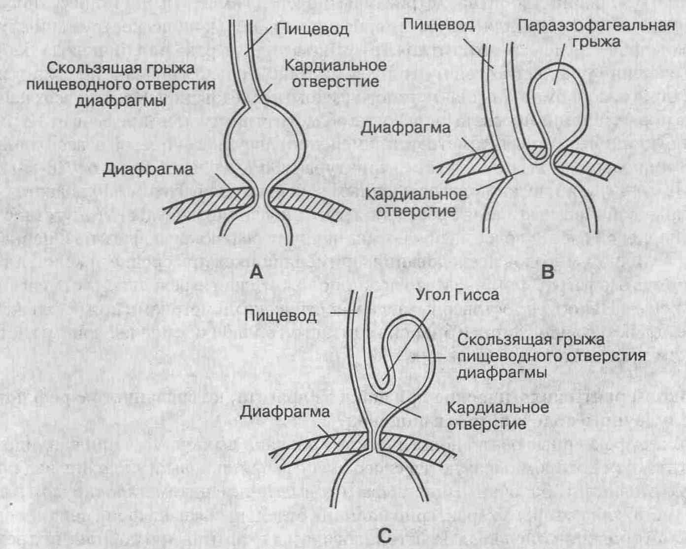 Аксиальная грыжа пищеводного отверстия диета без спорта Аксиальная грыжа пищеводного отверстия диета без спорта