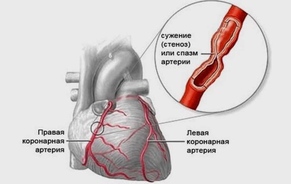 Сужение правой артерии. Спазм венечных артерий. Стенокардия Принцметалла. Спазм коронарных сосудов. Спазм коронарных артерий симптомы.