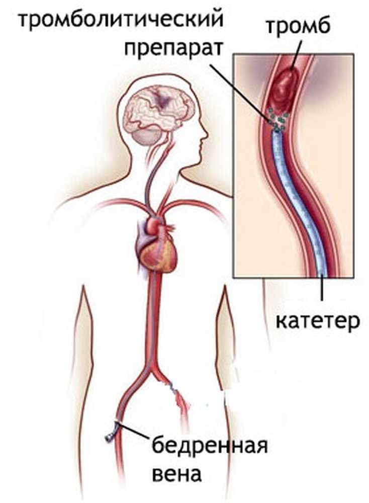 Катетер в бедренную вену