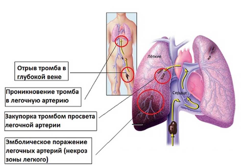 Оторвался тромб в легких. Закупорка тромбом легочной артерии. Закупорка легочных сосудов. Тромб из легочной артерии.