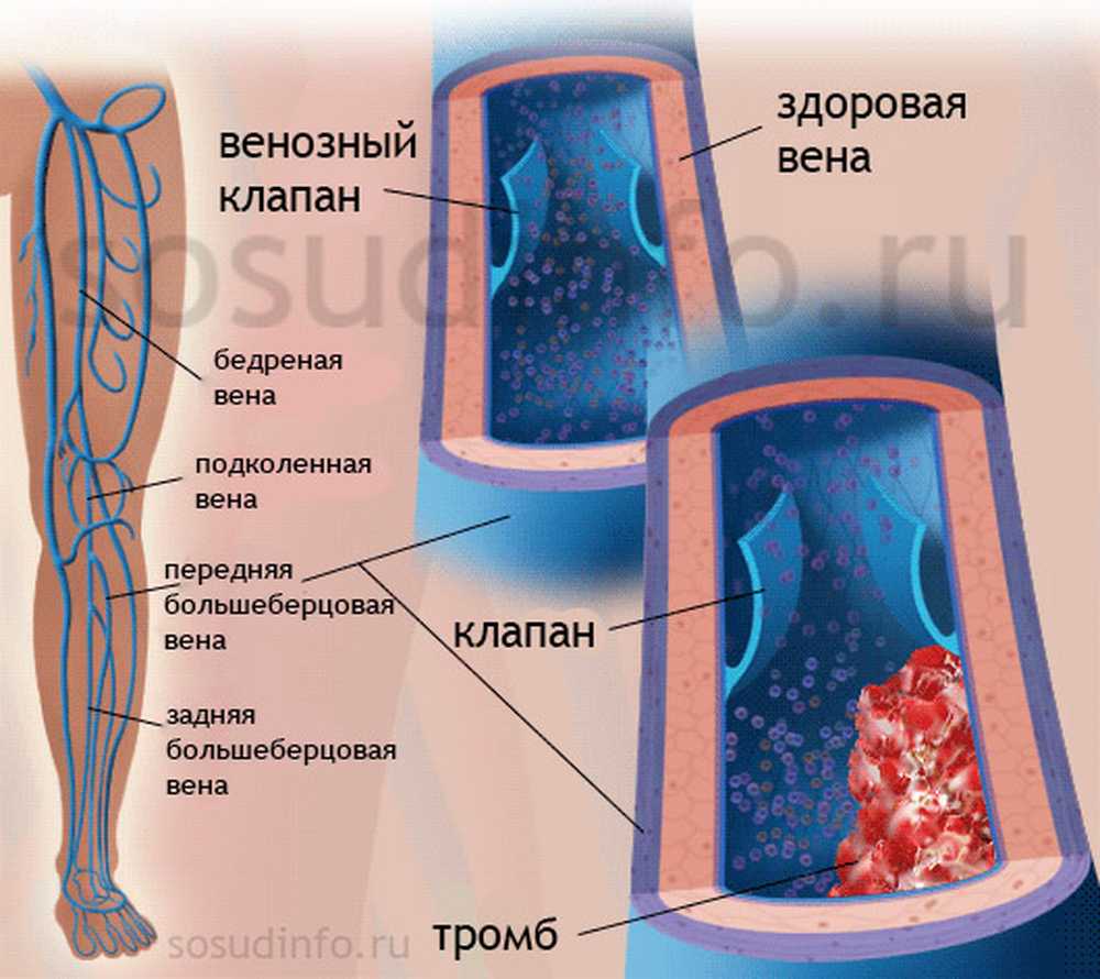 Тромбоз сосудов нижних