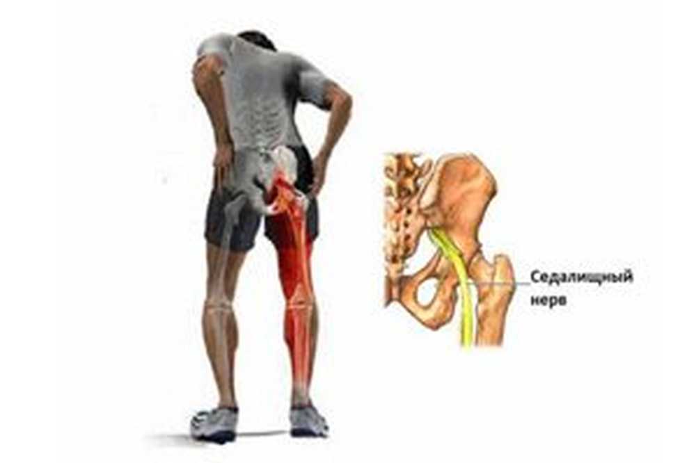 Защемило нерв. При защемлении седалищного нерва. Ишиас воспаление седалищного. Защемление седалищного нерва. Защемило седалищный нерв.